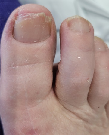 ripped toenail
